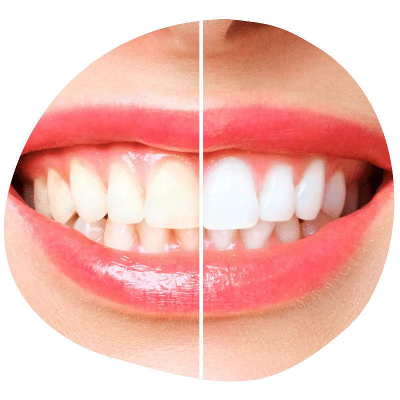 Blanqueamiento dental Benindorm