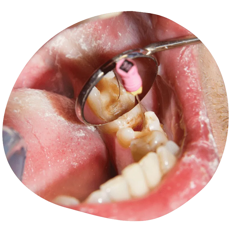 Endodoncia Benidorm