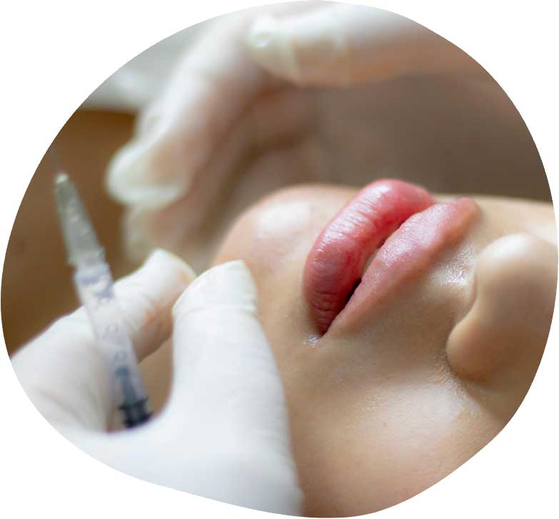 Aumento de Labios con Ácido Hialurónico
