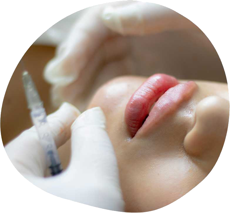 Aumento de Labios con Ácido Hialurónico
