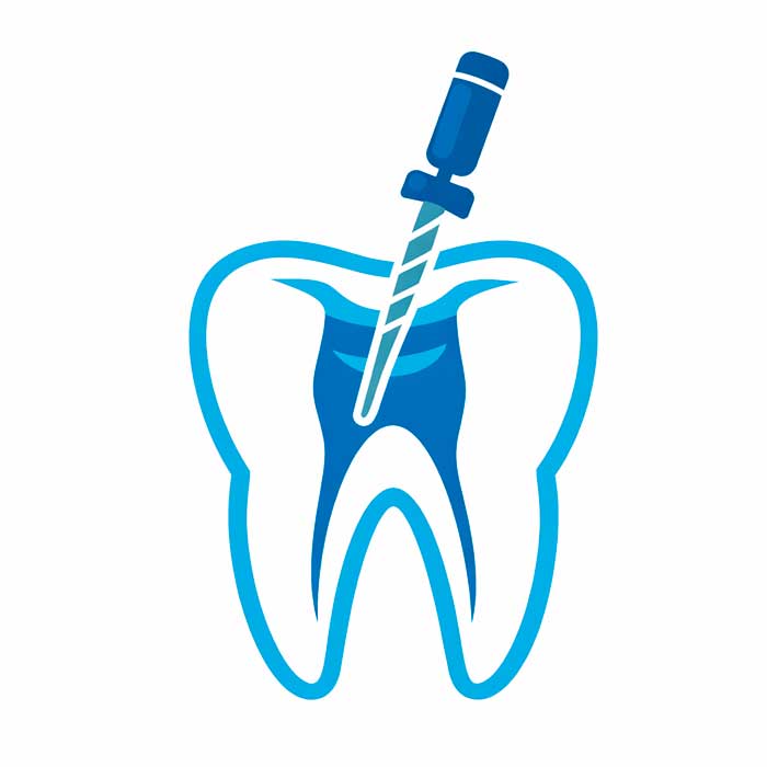 endodoncia en Benidorm