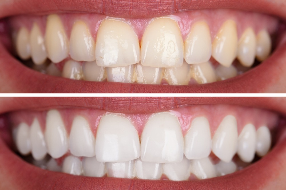 Blanqueamiento dental: mitos y verdades que debes conocer