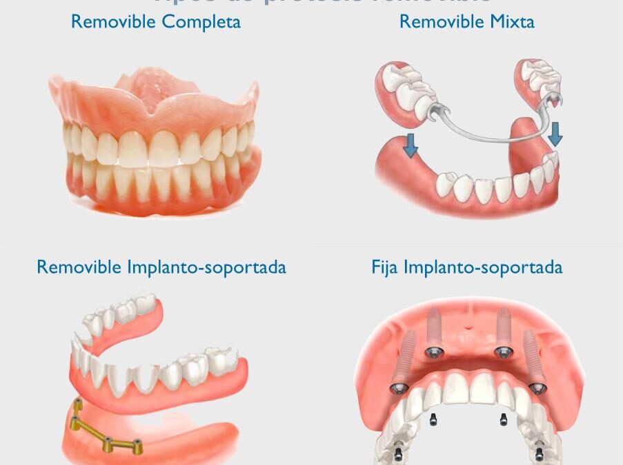 Implantes Dentales vs Prótesis Removible en Benidorm