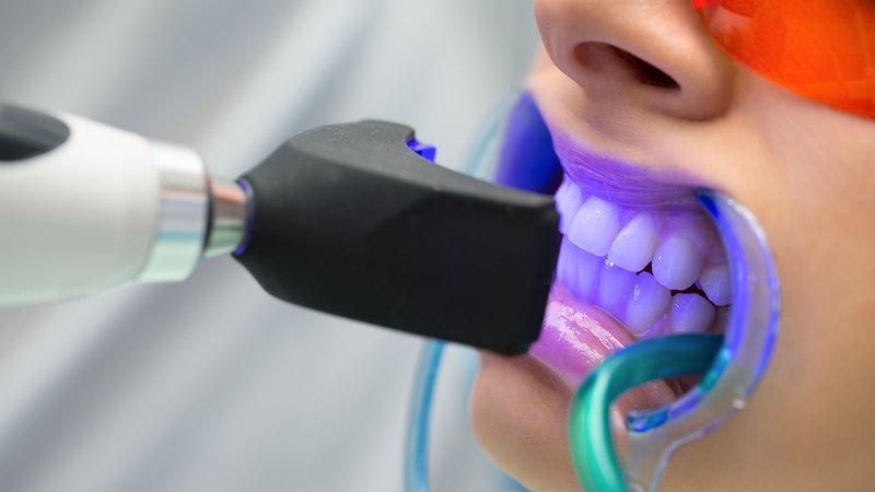 Professional Teeth Whitening in Benidorm